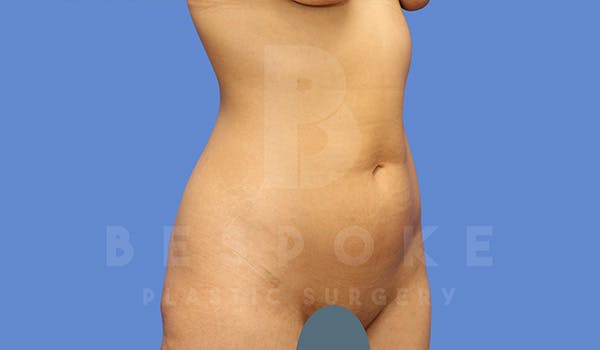 Petite Tuck Before & After Gallery - Patient 5090113 - Image 1