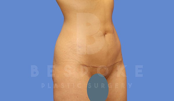Petite Tuck Before & After Gallery - Patient 5090113 - Image 2
