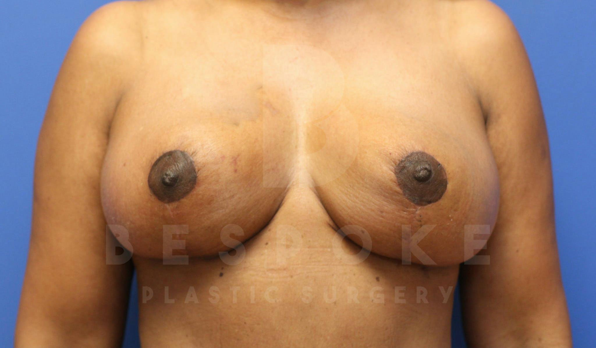 Breast Lift With Implants Before & After Gallery - Patient 5114566 - Image 2