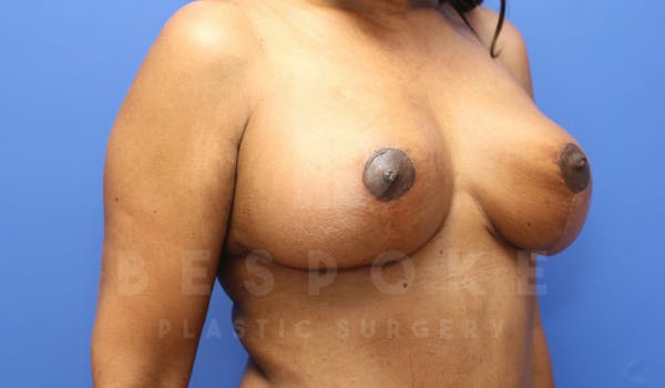Breast Lift With Implants Before & After Gallery - Patient 5114566 - Image 4