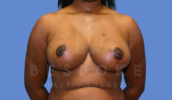 Breast Reduction Before & After Gallery - Patient 5164603 - Image 2