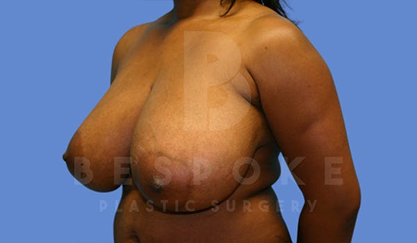 Breast Reduction Before & After Gallery - Patient 5164603 - Image 3