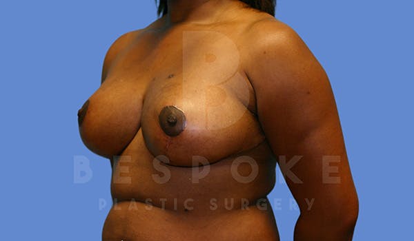 Breast Reduction Before & After Gallery - Patient 5164603 - Image 4