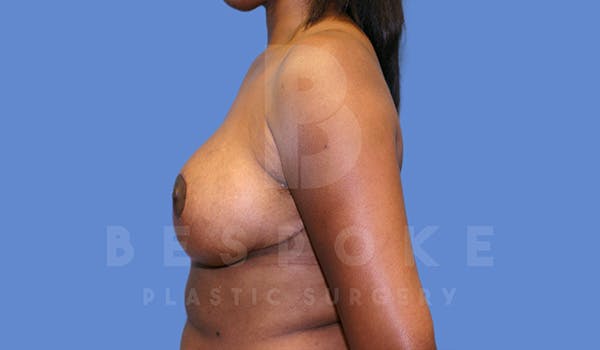 Breast Reduction Before & After Gallery - Patient 5164603 - Image 6