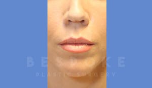 Facial Fat Transfer