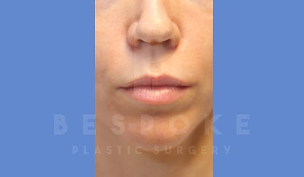 Facial Fat Transfer