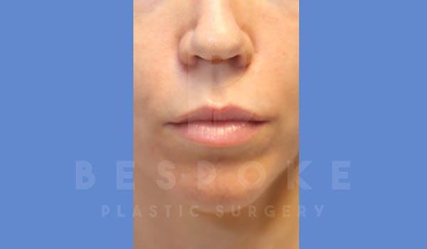 Facial Fat Grafting Before & After Gallery - Patient 5174672 - Image 1