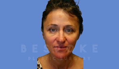 Fillers Before & After Gallery - Patient 5776238 - Image 1