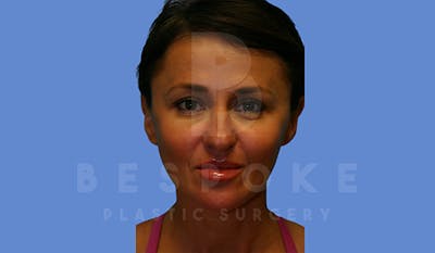 Fillers Before & After Gallery - Patient 5776238 - Image 2