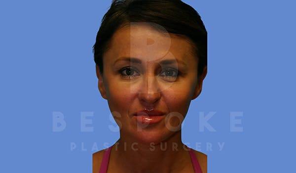 Fillers Before & After Gallery - Patient 5776238 - Image 2