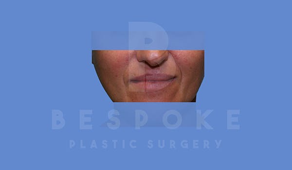 Fillers Before & After Gallery - Patient 5776239 - Image 1
