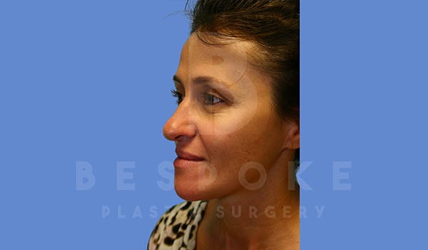 Fillers Before & After Gallery - Patient 5776238 - Image 3