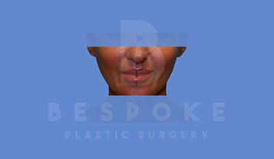Fillers Gallery - Patient 5776239 - Image 2