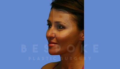 Fillers Before & After Gallery - Patient 5776238 - Image 4