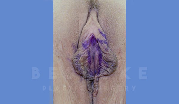 Labiaplasty Before & After Gallery - Patient 5776240 - Image 1
