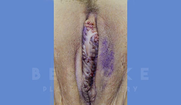 Labiaplasty Before & After Gallery - Patient 5776240 - Image 2