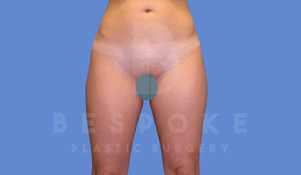 Liposuction Before & After Gallery - Patient 5776245 - Image 1