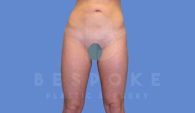 Liposuction Before & After Gallery - Patient 5776245 - Image 2