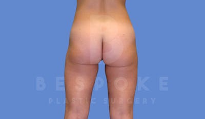 Liposuction Before & After Gallery - Patient 5776245 - Image 4