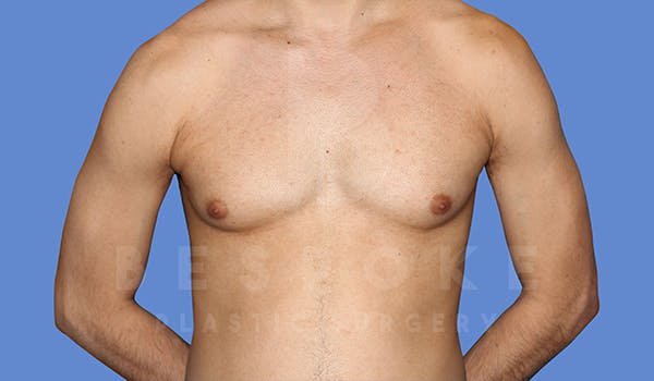 Gynecomastia Before & After Gallery - Patient 5776248 - Image 1