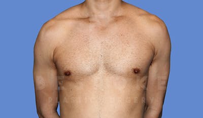 Gynecomastia Before & After Gallery - Patient 5776248 - Image 2