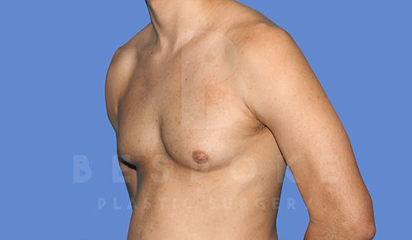 Gynecomastia Before & After Gallery - Patient 5776248 - Image 3