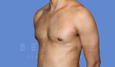 Gynecomastia Before & After Gallery - Patient 5776248 - Image 4