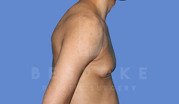 Gynecomastia Before & After Gallery - Patient 5776248 - Image 5