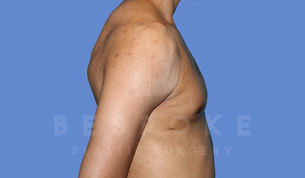 Gynecomastia Before & After Gallery - Patient 5776248 - Image 6