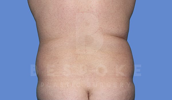 Liposuction Before & After Gallery - Patient 5776250 - Image 1