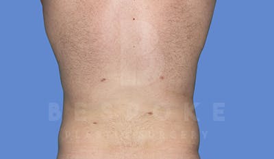 Liposuction Before & After Gallery - Patient 5776250 - Image 2