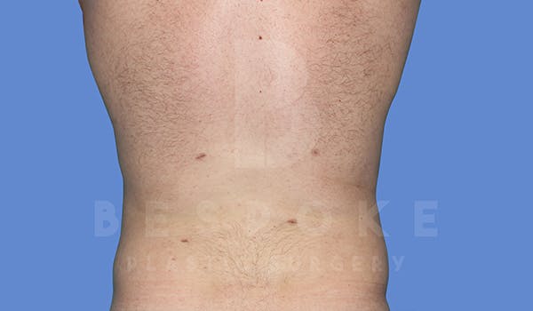 Liposuction Before & After Gallery - Patient 5776250 - Image 2