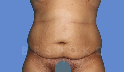 Massive Weight Loss Before & After Gallery - Patient 5776251 - Image 1