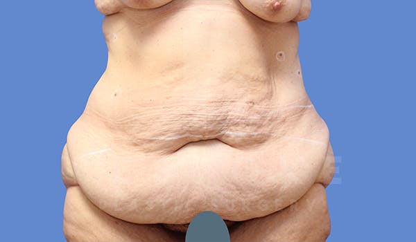 Massive Weight Loss Before & After Gallery - Patient 5776253 - Image 1