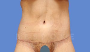 Charlotte NC Body Contouring Results