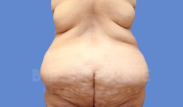Massive Weight Loss Before & After Gallery - Patient 5776253 - Image 5