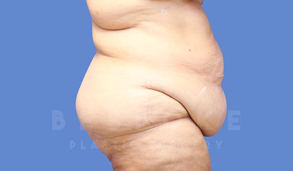Massive Weight Loss Before & After Gallery - Patient 5776253 - Image 7