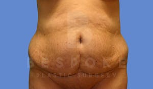 Charlotte NC Body Contouring Results