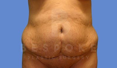 Massive Weight Loss Before & After Gallery - Patient 5776255 - Image 1