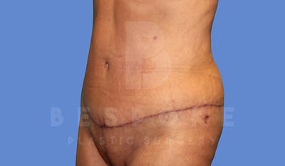 Massive Weight Loss Before & After Gallery - Patient 5776255 - Image 4