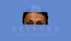 Charlotte NC Botox Before & After Photos