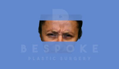 BOTOX/Dysport Before & After Gallery - Patient 5776261 - Image 1