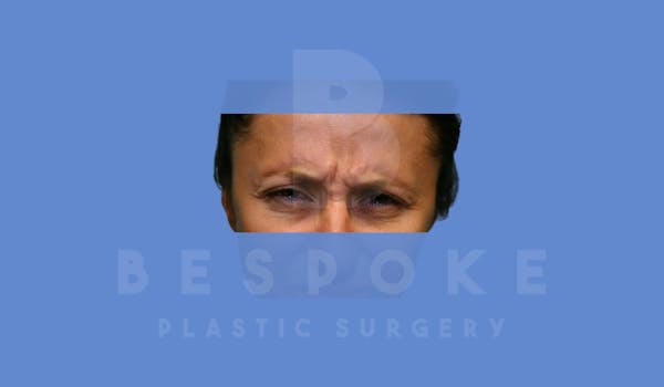 BOTOX/Dysport Before & After Gallery - Patient 5776261 - Image 1