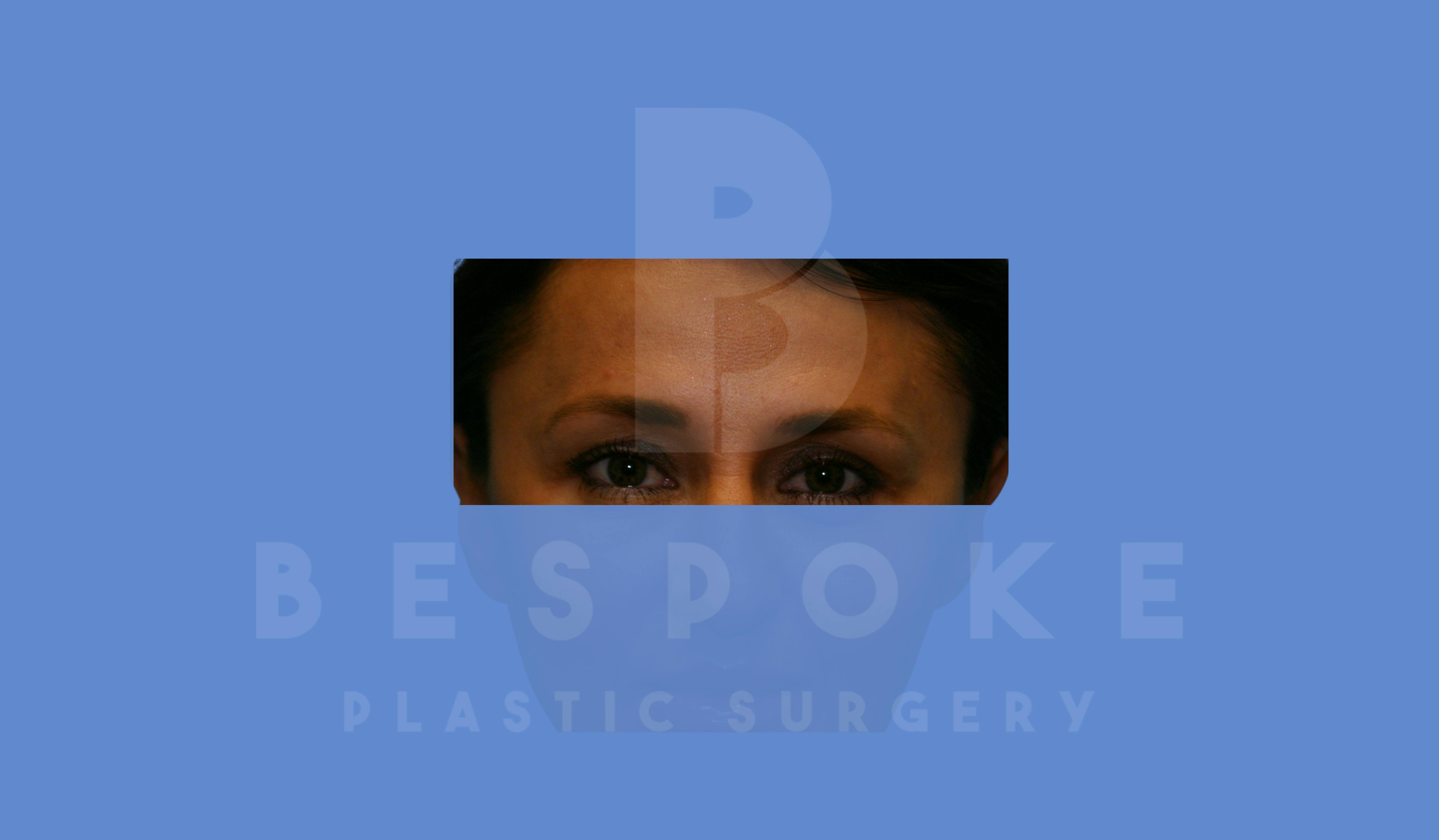 BOTOX/Dysport Before & After Gallery - Patient 5776260 - Image 2