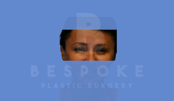 BOTOX/Dysport Before & After Gallery - Patient 5776261 - Image 2