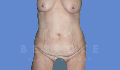 Tummy Tuck Before & After Gallery - Patient 5776273 - Image 1