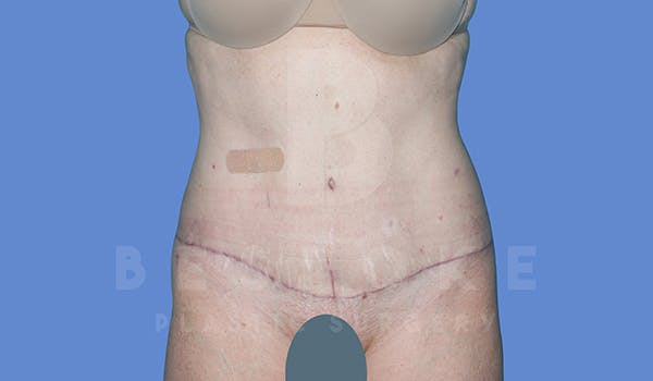 Tummy Tuck Gallery - Patient 5776273 - Image 2