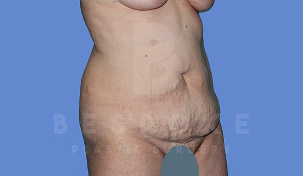Tummy Tuck Before & After Gallery - Patient 5776273 - Image 3