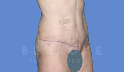 Tummy Tuck Before & After Gallery - Patient 5776273 - Image 4