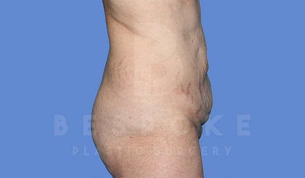 Tummy Tuck Before & After Gallery - Patient 5776273 - Image 5
